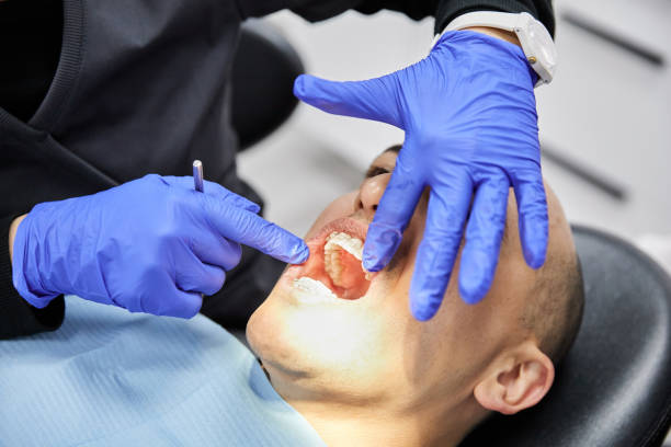Best Emergency Wisdom Tooth Extraction in Fairview Park, OH